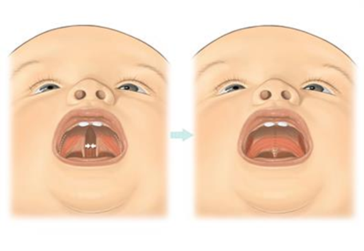 Cleft Palate Repair in Kanpur