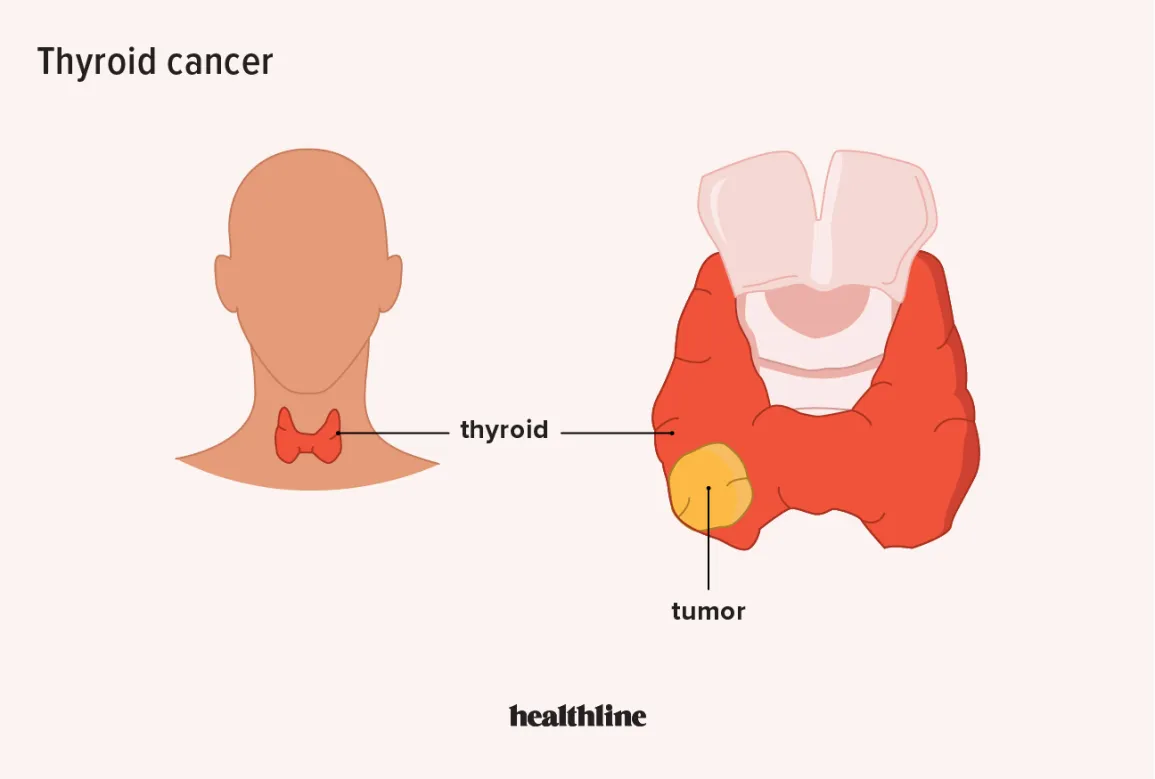 Thyroid cancer in Kanpur