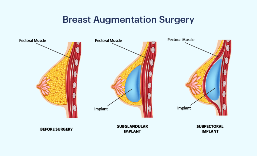 Breast Augmentation in Kanpur