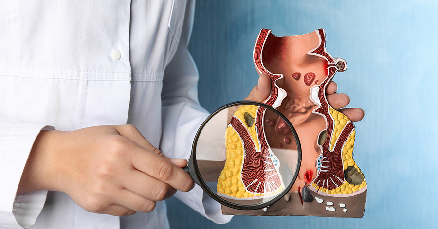 Piles Surgery in kanpur